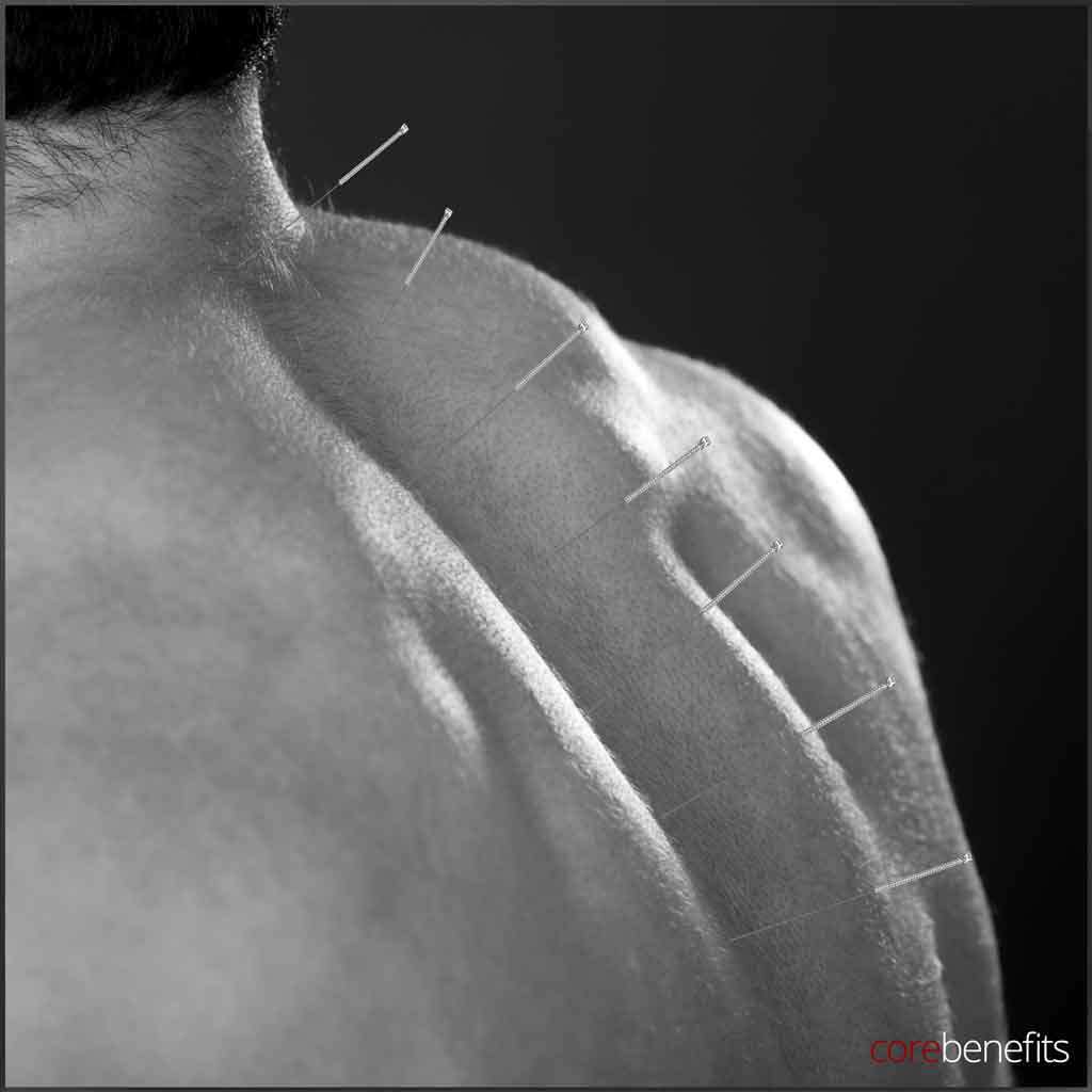 Close-up image showing acupuncture needles along a man's shoulder, illustrating Core Benefits Toowoomba's dry needling therapy. Embrace 'Bare to Bold: Effortless Confidence' with this precise technique designed for pain relief and muscular healing.