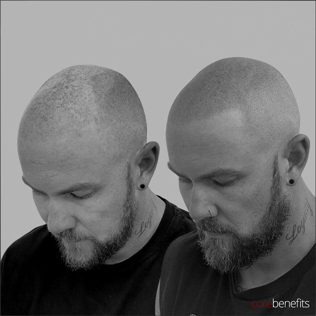 Man's Guide to Scalp Micropigmentation (SMP) - Core Benefits Toowoomba