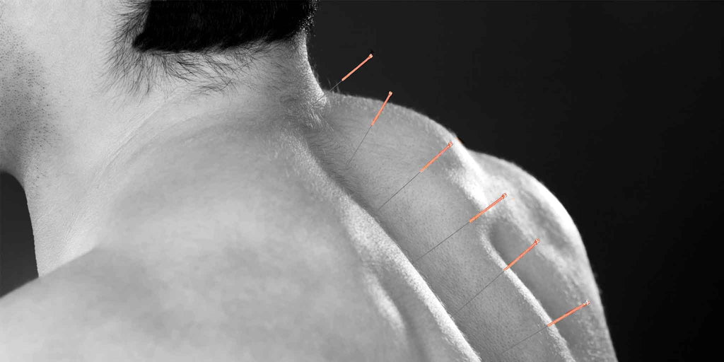 Dry Needling Toowoomba. Acupuncture Toowoomba. Core Benefits Toowoomba. 23 Albert Street, Newtown, QLD, 4350. Peak Performance Sports Physiotherapy.