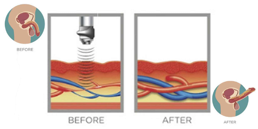 Erectile dysfunction treatment, ultrasonic wave therapy for ed