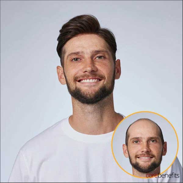 Unrivaled Realism with The Dominator Hair System | 0.06mm Poly Thin Skin - Core Benefits Toowoomba - Hair System